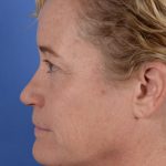 Primary Rhinoplasty Before & After Patient #3105