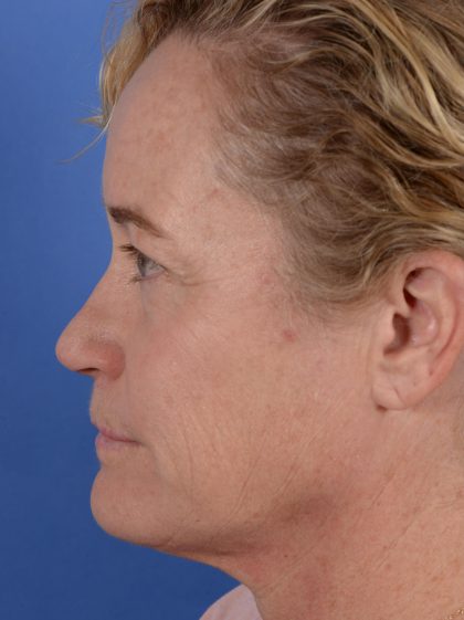 Primary Rhinoplasty Before & After Patient #3105