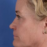 Primary Rhinoplasty Before & After Patient #3105