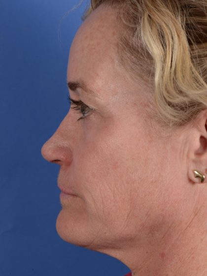 Primary Rhinoplasty Before & After Patient #3105