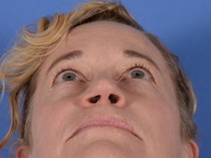 Primary Rhinoplasty Before & After Patient #3105