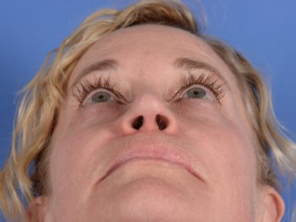 Primary Rhinoplasty Before & After Patient #3105