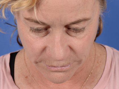 Primary Rhinoplasty Before & After Patient #3105