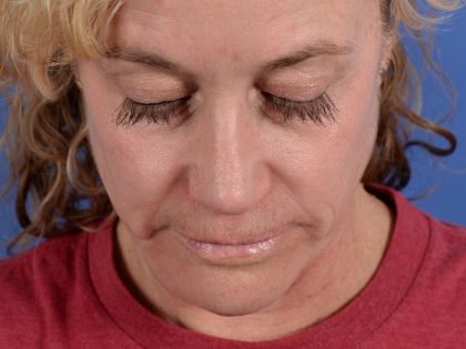 Primary Rhinoplasty Before & After Patient #3105