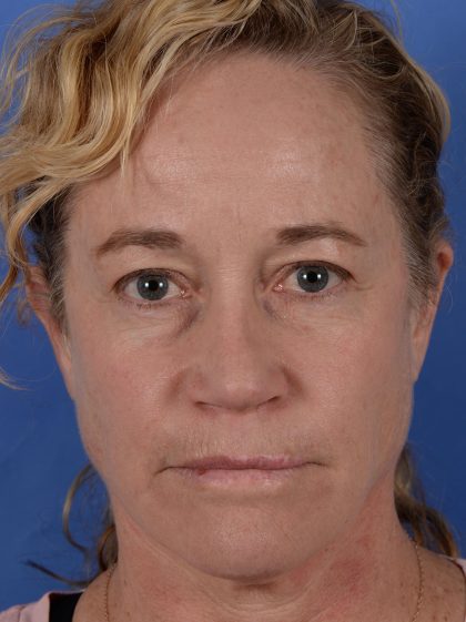 Primary Rhinoplasty Before & After Patient #3105
