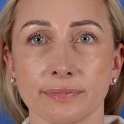 Revision Rhinoplasty Before & After Patient #3132
