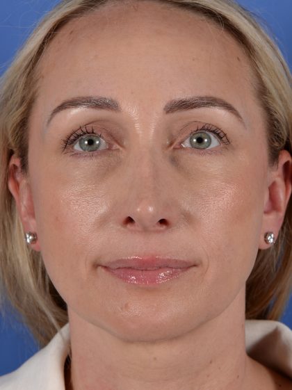 Revision Rhinoplasty Before & After Patient #3132