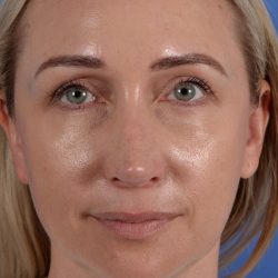 Revision Rhinoplasty Before & After Patient #3132