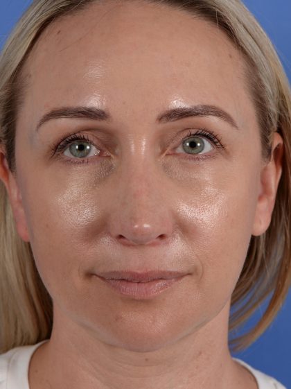 Revision Rhinoplasty Before & After Patient #3132