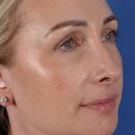 Revision Rhinoplasty Before & After Patient #3132