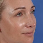 Revision Rhinoplasty Before & After Patient #3132