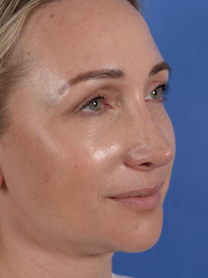 Revision Rhinoplasty Before & After Patient #3132