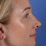 Revision Rhinoplasty Before & After Patient #3132