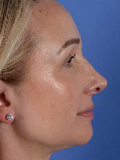 Revision Rhinoplasty Before & After Patient #3132