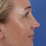 Revision Rhinoplasty Before & After Patient #3132