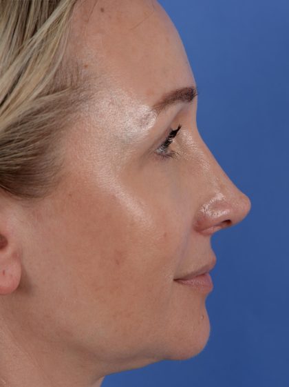 Revision Rhinoplasty Before & After Patient #3132
