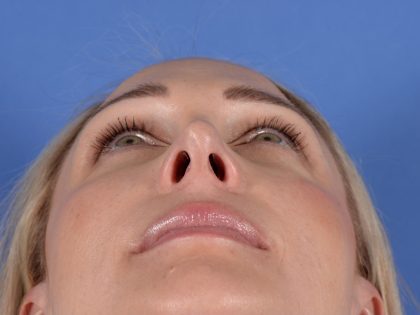 Revision Rhinoplasty Before & After Patient #3132