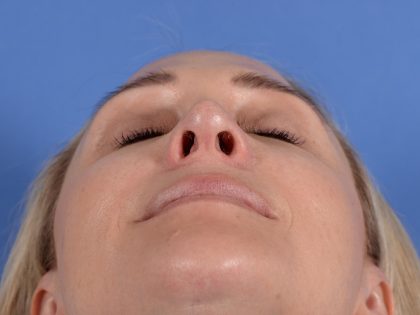 Revision Rhinoplasty Before & After Patient #3132