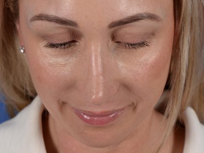 Revision Rhinoplasty Before & After Patient #3132