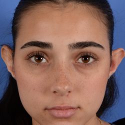 Otoplasty Before & After Patient #3143
