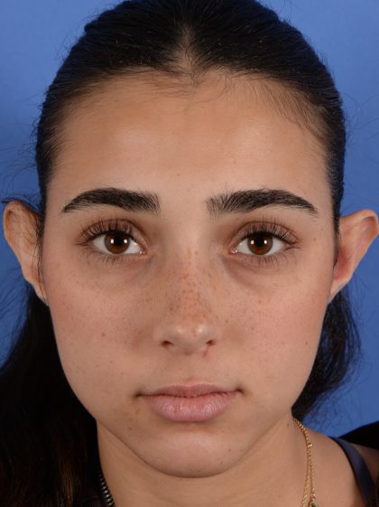 Otoplasty Before & After Patient #3143