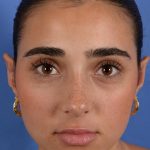 Otoplasty Before & After Patient #3143