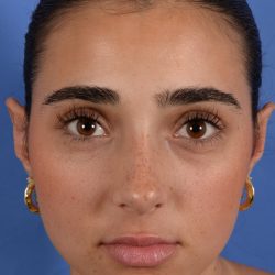 Otoplasty Before & After Patient #3143