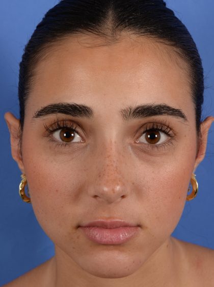 Otoplasty Before & After Patient #3143