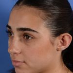 Otoplasty Before & After Patient #3143