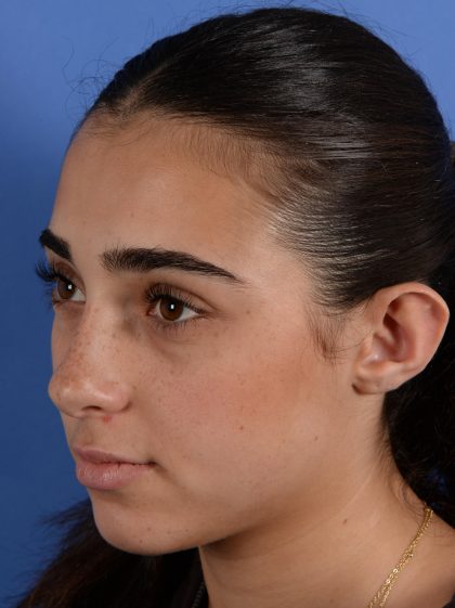 Otoplasty Before & After Patient #3143
