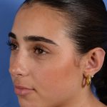 Otoplasty Before & After Patient #3143