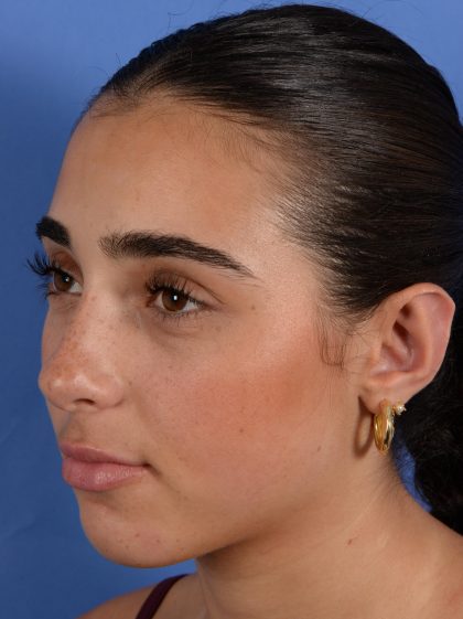 Otoplasty Before & After Patient #3143