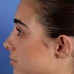 Otoplasty Before & After Patient #3143