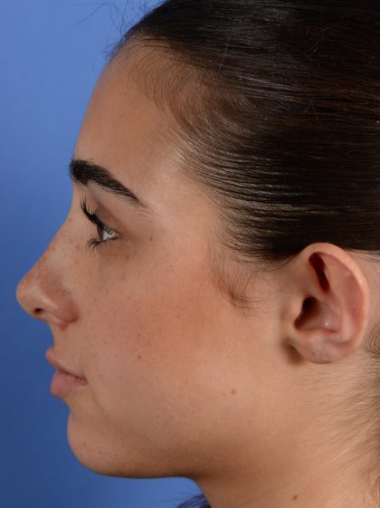 Otoplasty Before & After Patient #3143