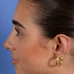 Otoplasty Before & After Patient #3143