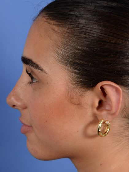 Otoplasty Before & After Patient #3143