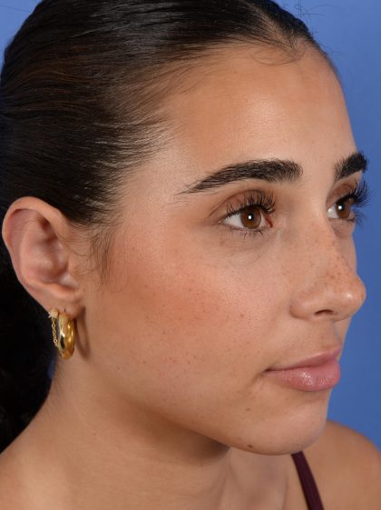 Otoplasty Before & After Patient #3143