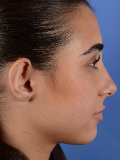 Otoplasty Before & After Patient #3143